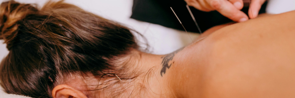 Dry Needling